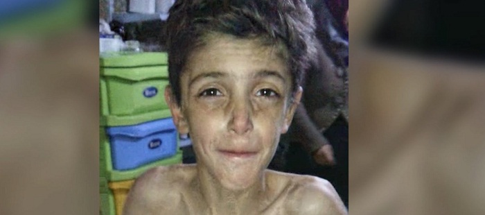 Children Are Starving To Death In Madaya, Syria - VIDEO